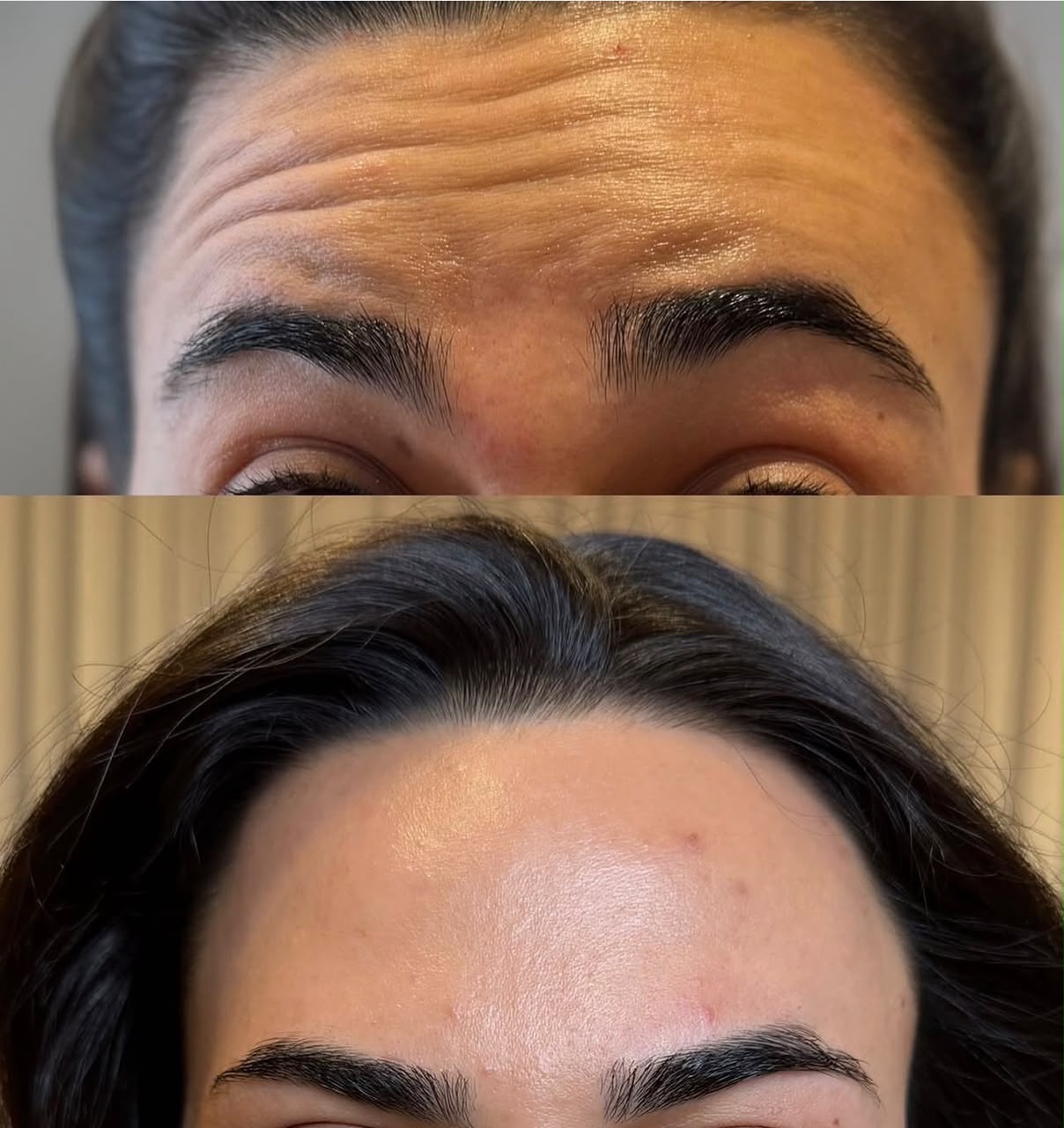 Botox du front : soin réalisé au cabinet