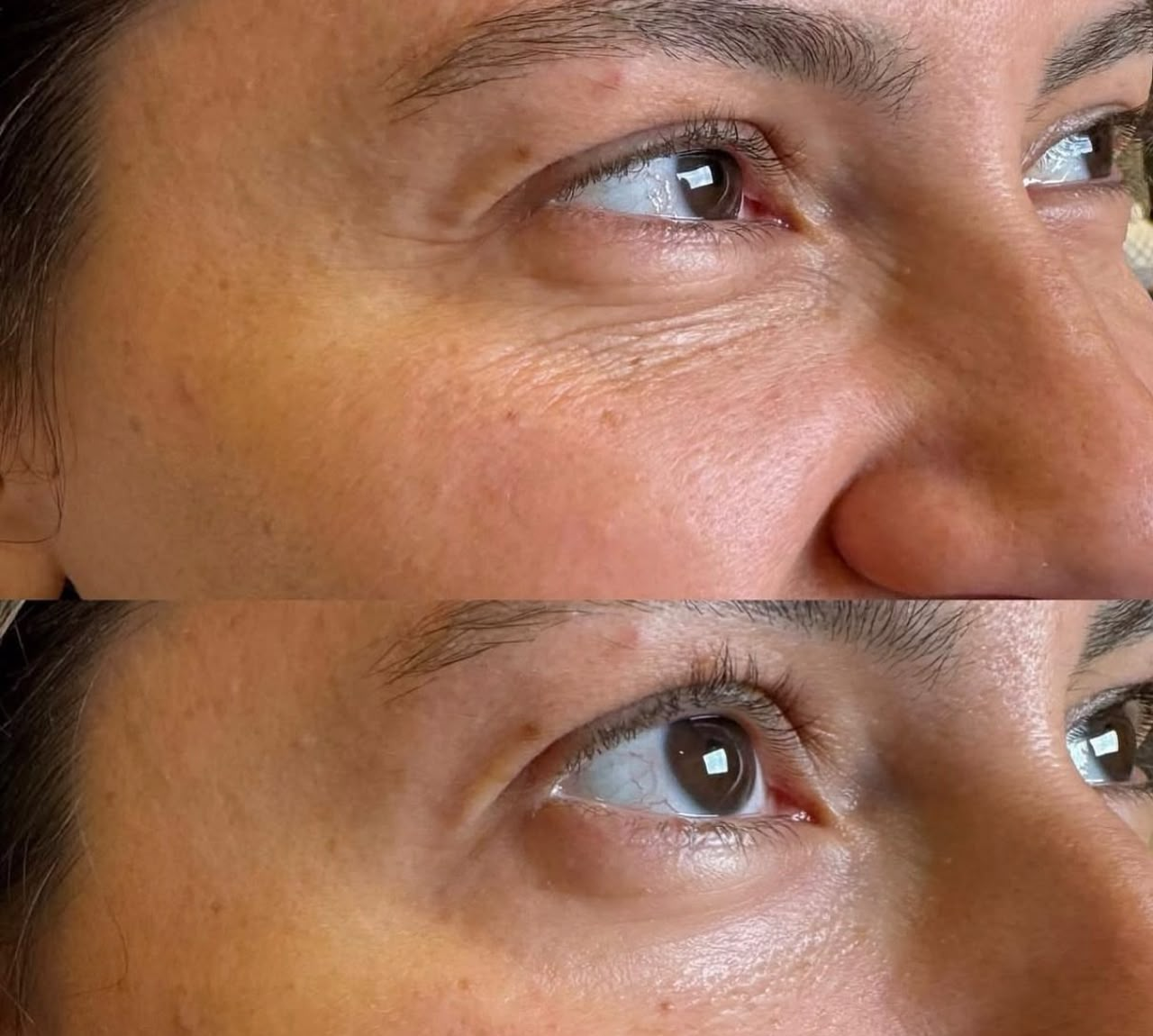 Traitement du contour des yeux : soin réalisé au cabinet