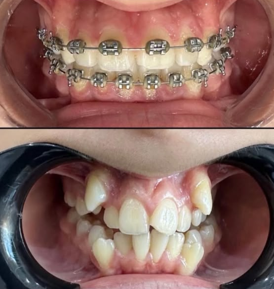 Orthodontie multi-brackets : soin réalisé au cabinet